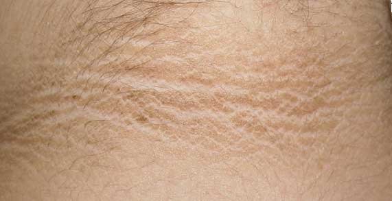 Acanthosis Nigricans: quella striscia nera sul collo