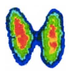 Scintigrafia tiroidea: informazioni utili