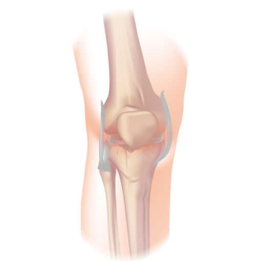 patologie del Ginocchio