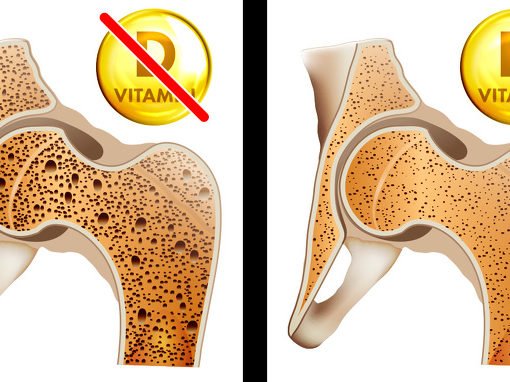 Osteoporosi Vitamina D